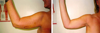 Upper arm – before and after