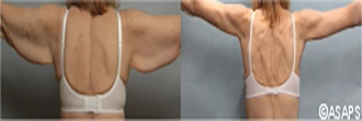 Upper arm – before and after