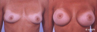 Breast surgery – before and after