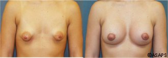 Breast surgery – before and after
