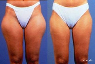 Liposuction – before and after