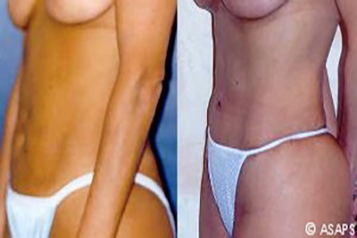 Tummy tuck – before and after