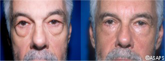 Eyelid surgery – before and after