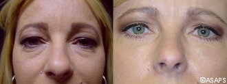 Eyelid surgery – before and after