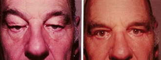 Eyelid surgery – before and after