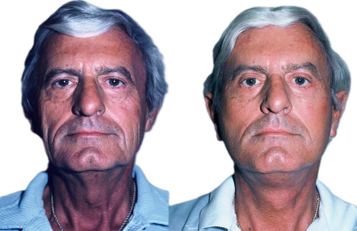 Facelift – before and after