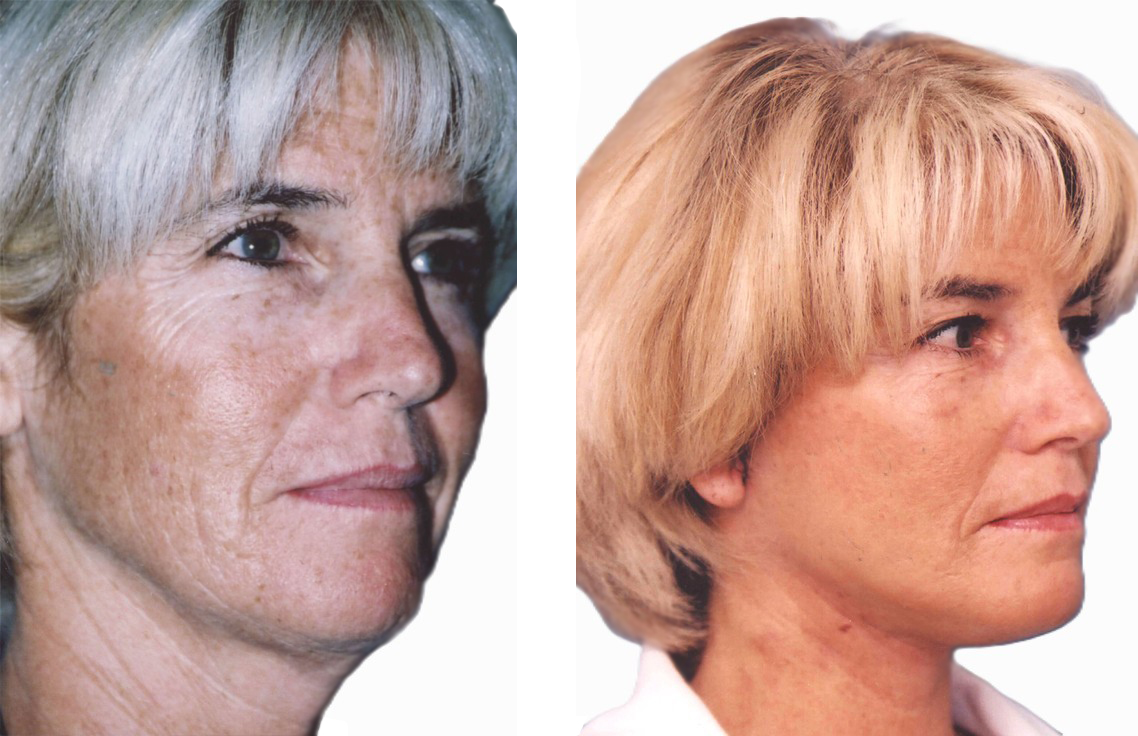 Facelift – before and after