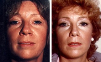 Facelift – before and after