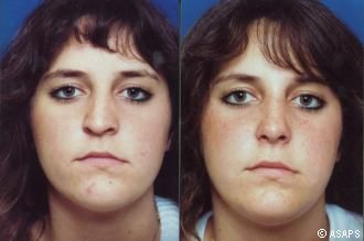 Rhinoplasty – before and after