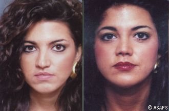 Rhinoplasty – before and after