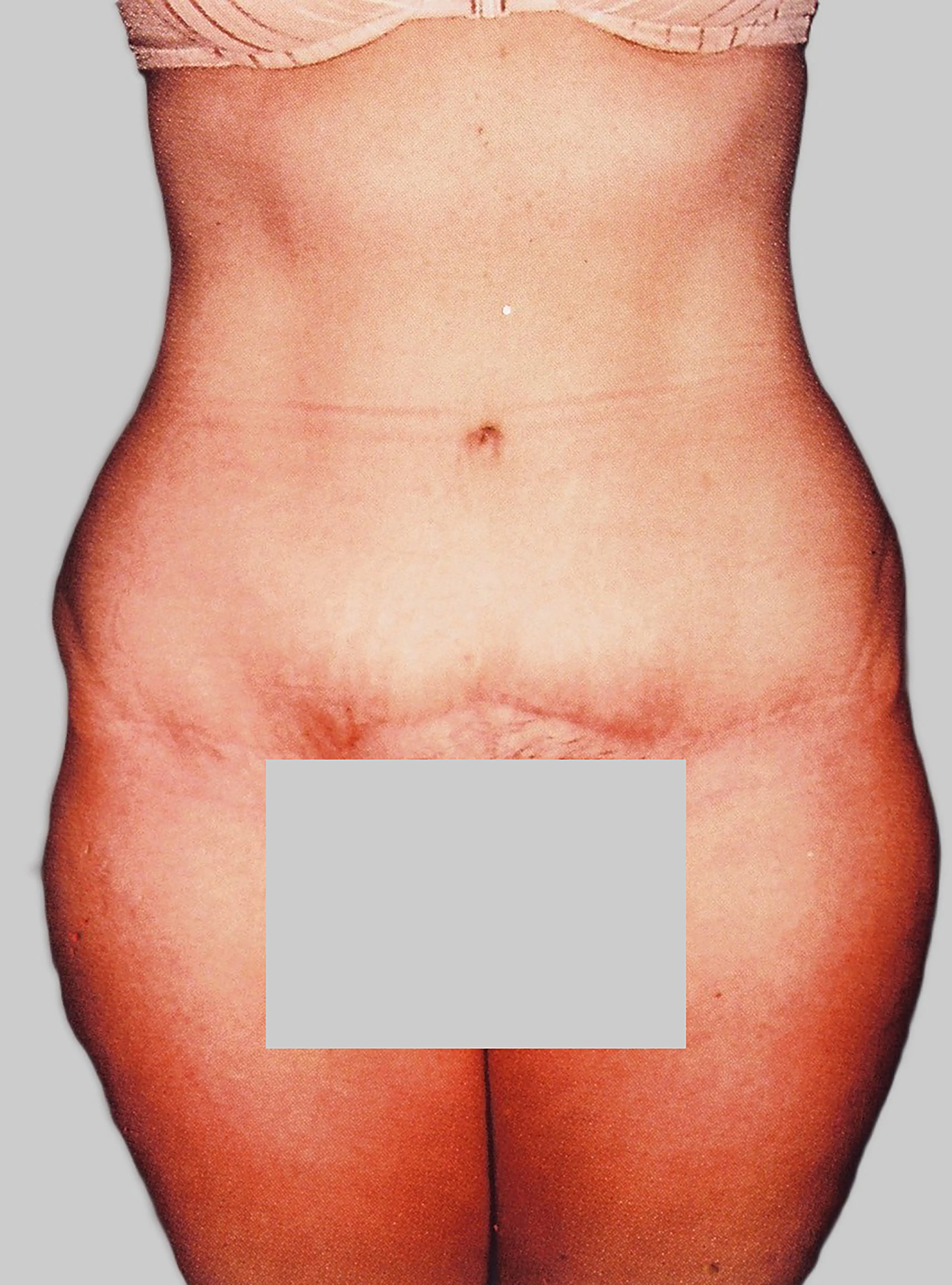 Body Contouring After
