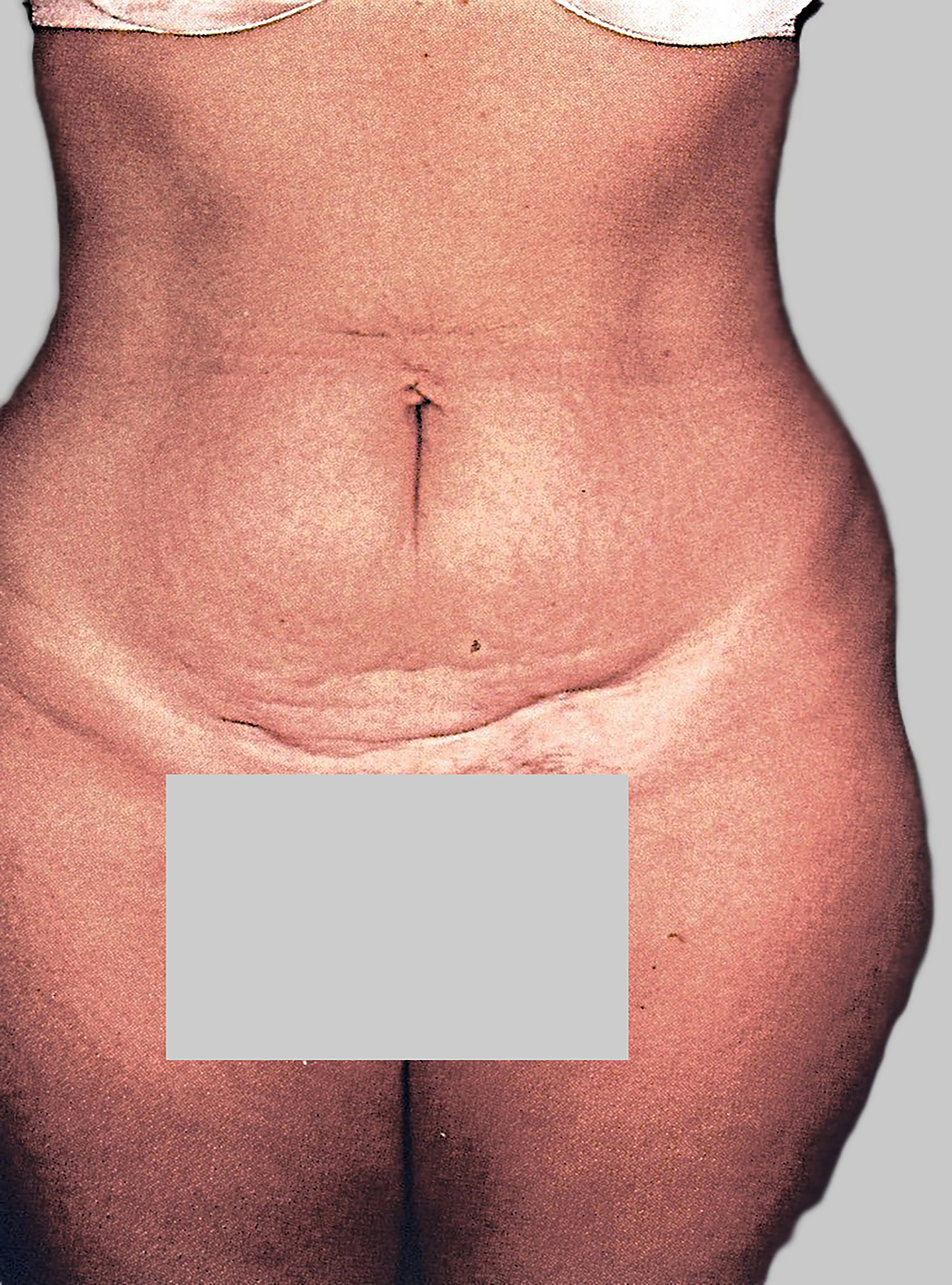 Body Contouring Before