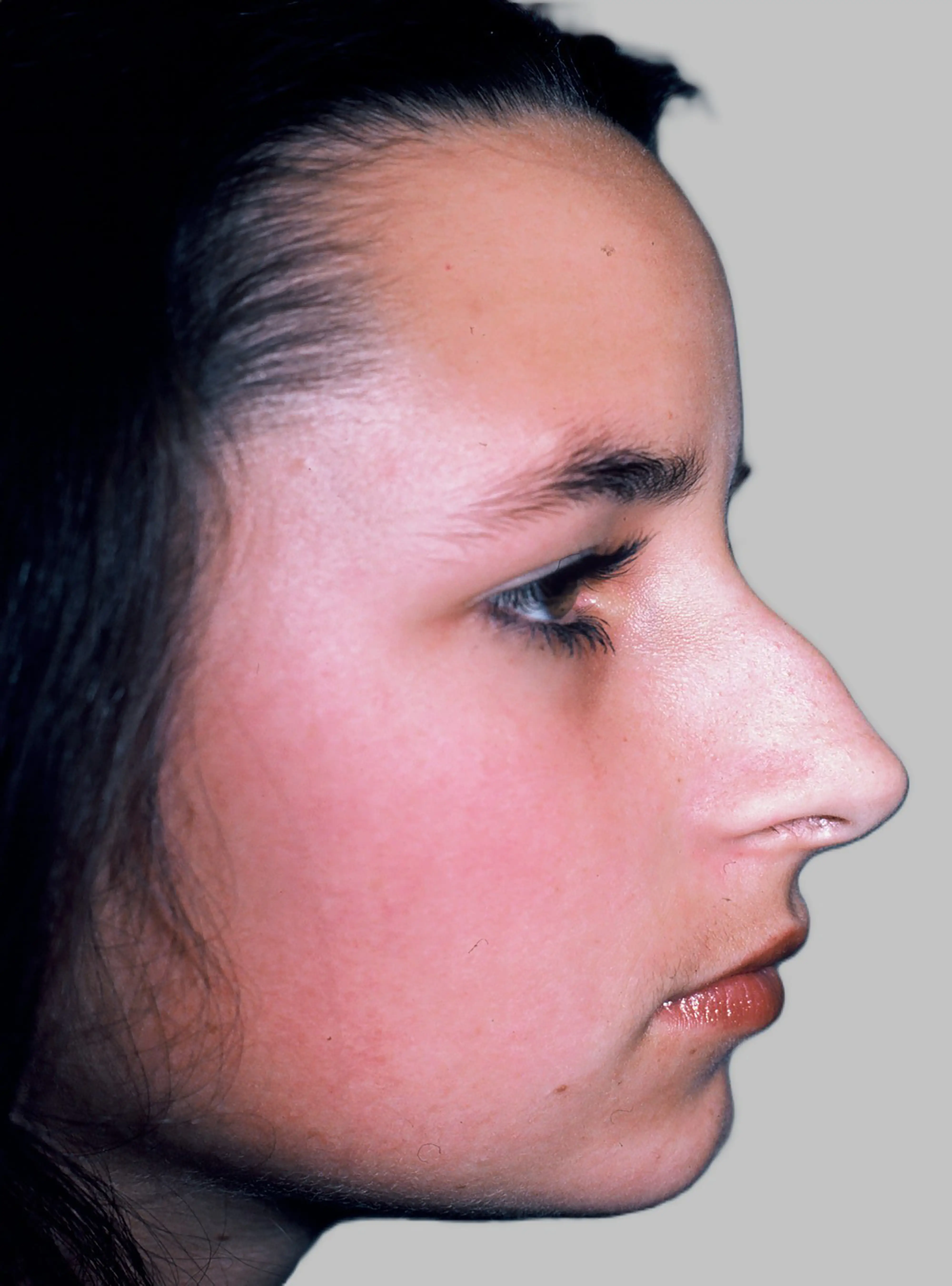 Rhinoplasty Before
