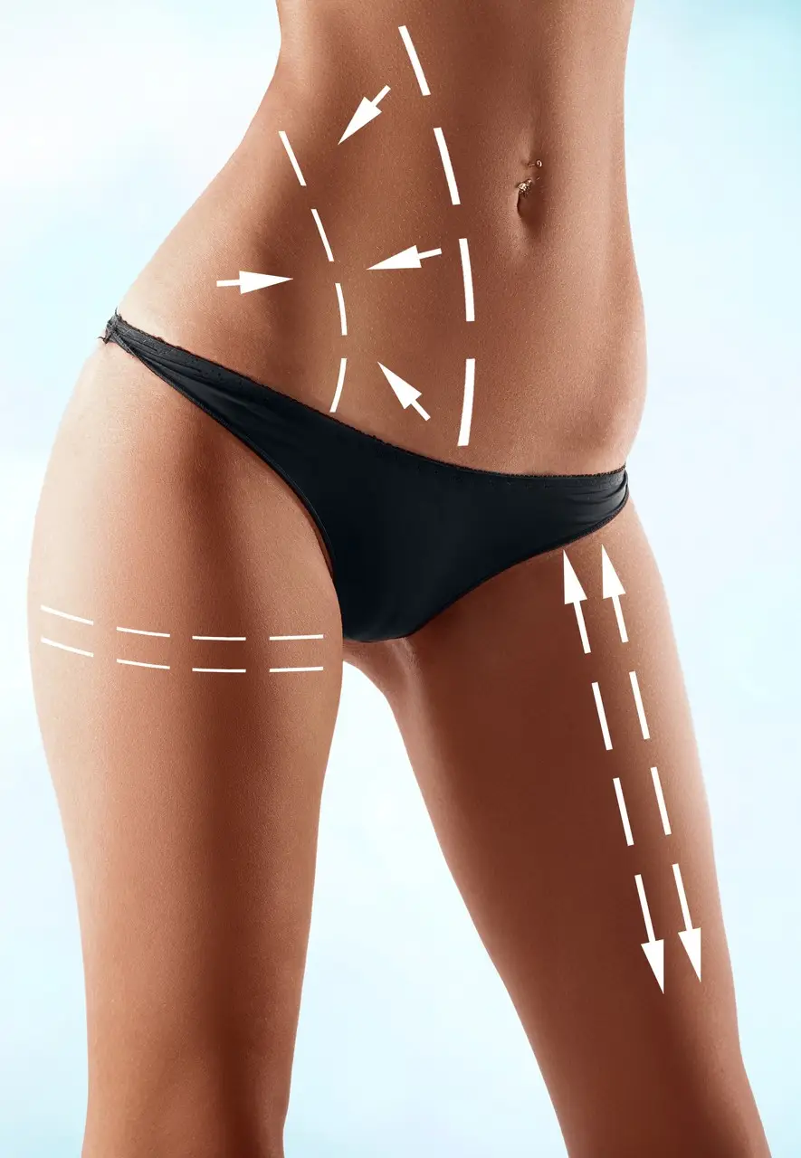Liposuction